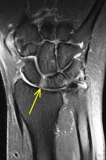 Figure 2 for case scapholunate ligament tear ( RID2259 )